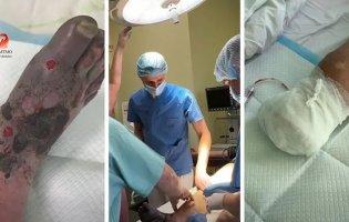 У Ковелі чоловіку ампутували обморожену ногу