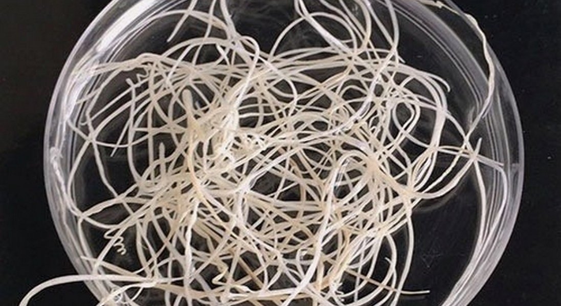 На Волині з чоловіка витягли 15-сантиметрового паразита