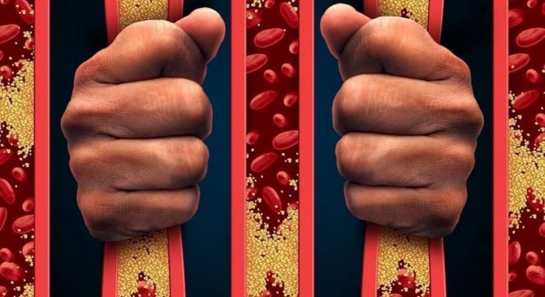 Бляшки в судинах: у кого вони утворюються та коли стають небезпечні