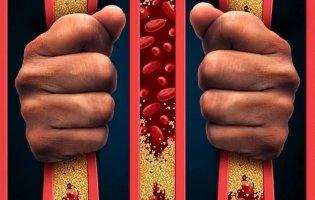 Бляшки в судинах: у кого вони утворюються та коли стають небезпечні