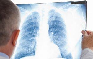 Скільки випадків туберкульозу зафіксували на Волині минулоріч